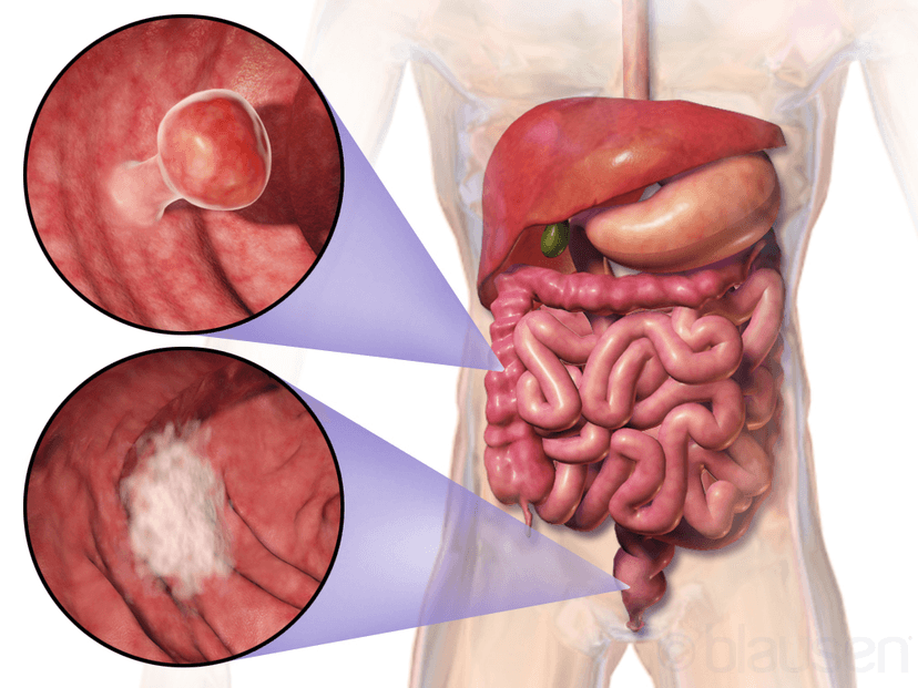 Il SUS include un test ad alta tecnologia per lo screening del cancro colorettale